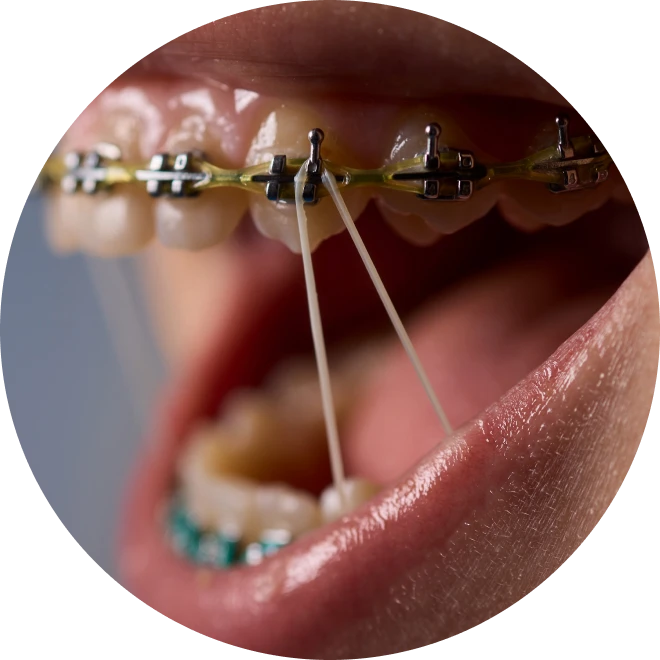 Les élastiques : à quoi ça sert ?